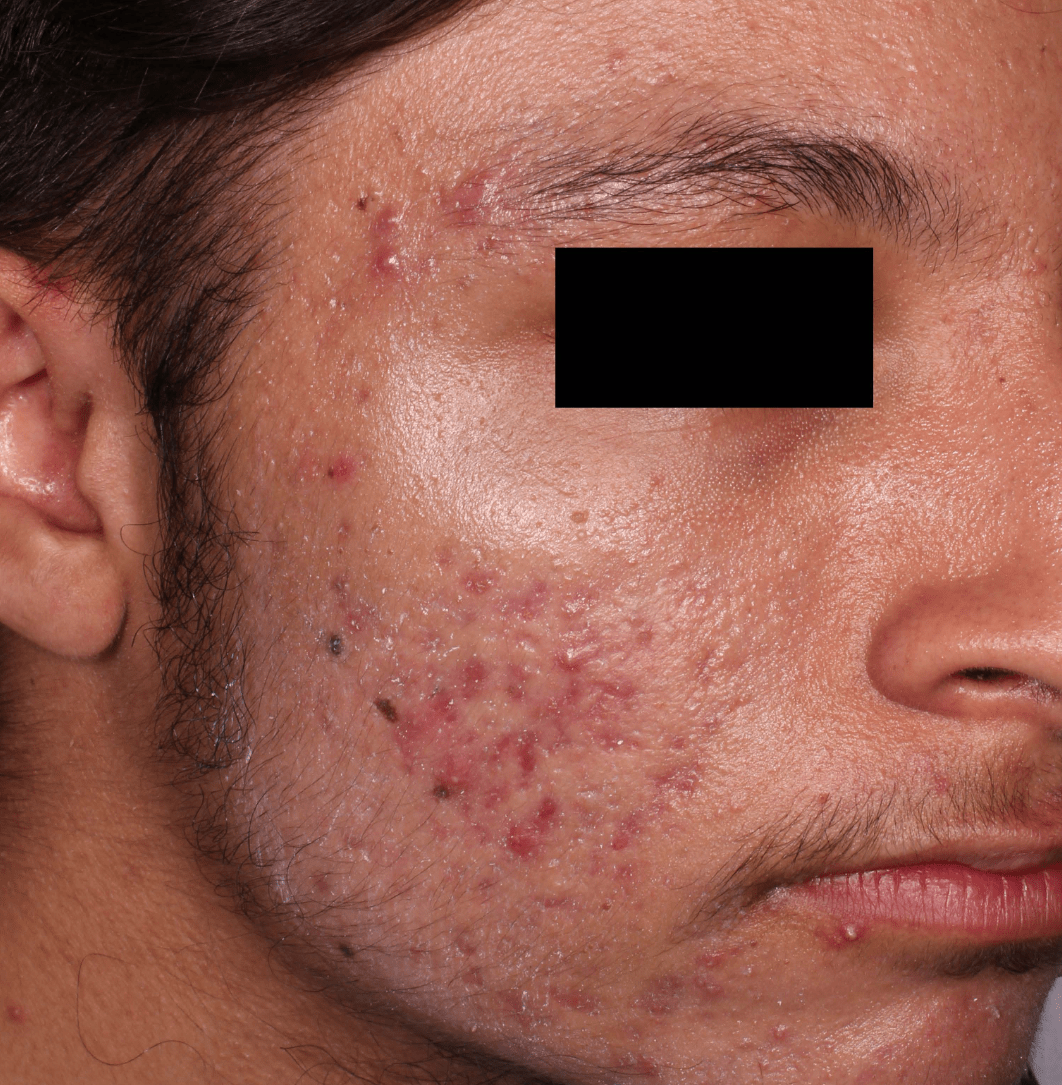 Before-and-after image of CABTREO patient